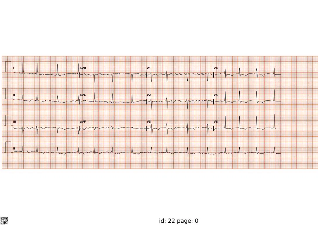 نشانه گذاری موج های ECG توسط هوش مصنوعی