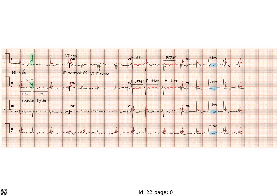 تصویر اصلی نوار قلب ECG
